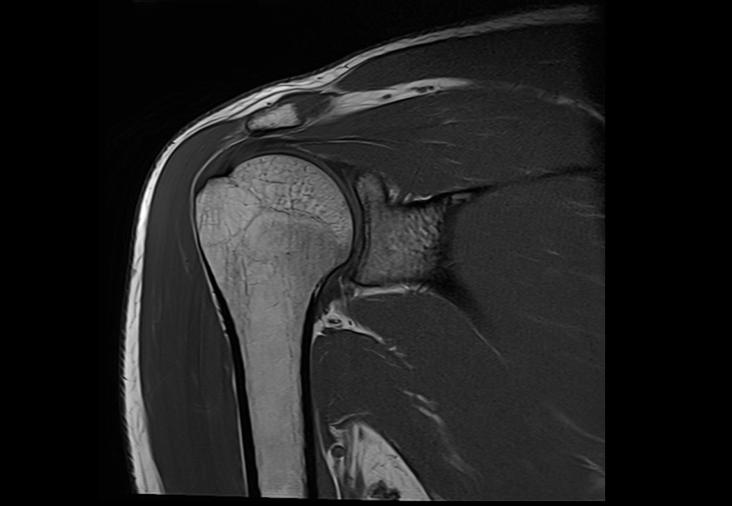 MRI T1-weighted turbo spin-echo coronal image of the shoulder