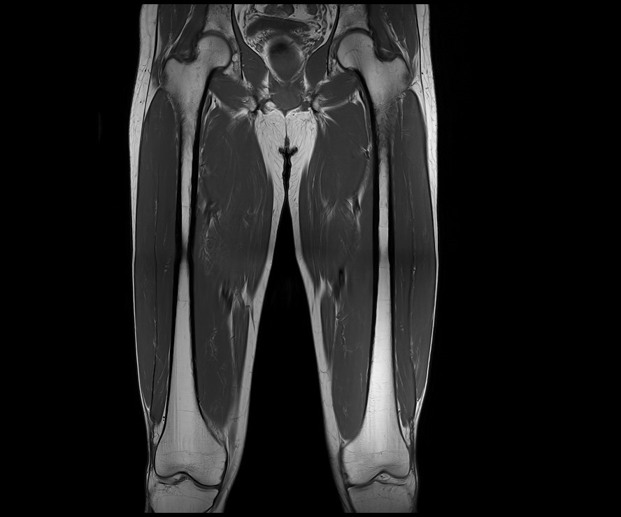 T1-weighted turbo spin-echo coronal image of the thigh