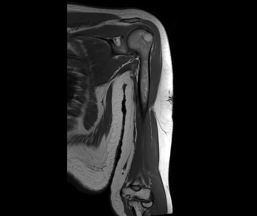 T1-weighted turbo spin-echo coronal image of the upper arm