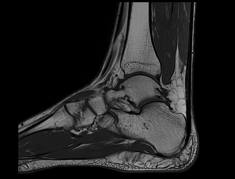 T1-weighted turbo spin-echo sagittal image of the ankle