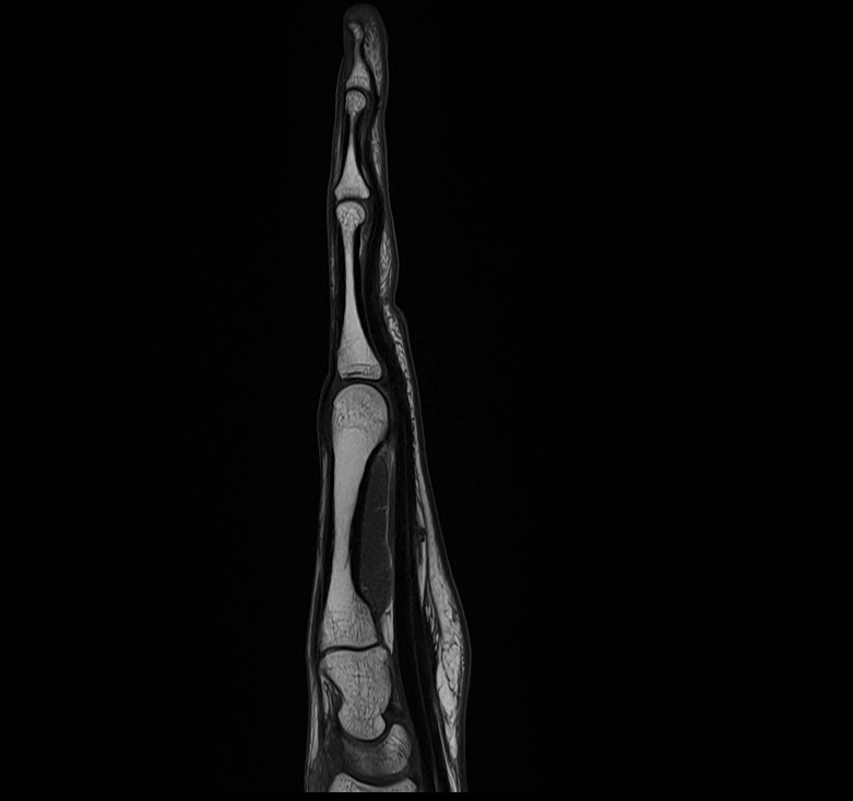T1-weighted turbo spin-echo sagittal image of the hand
