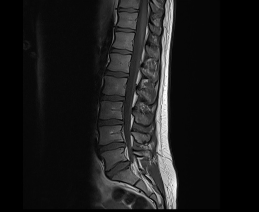 T1-weighted turbo spin-echo sagittal image of the lumbar spine