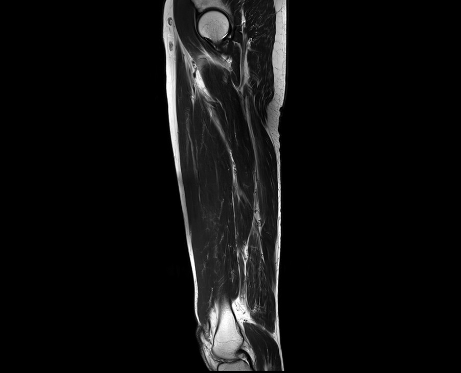 T2 Sagittal sequence used in thigh imaging