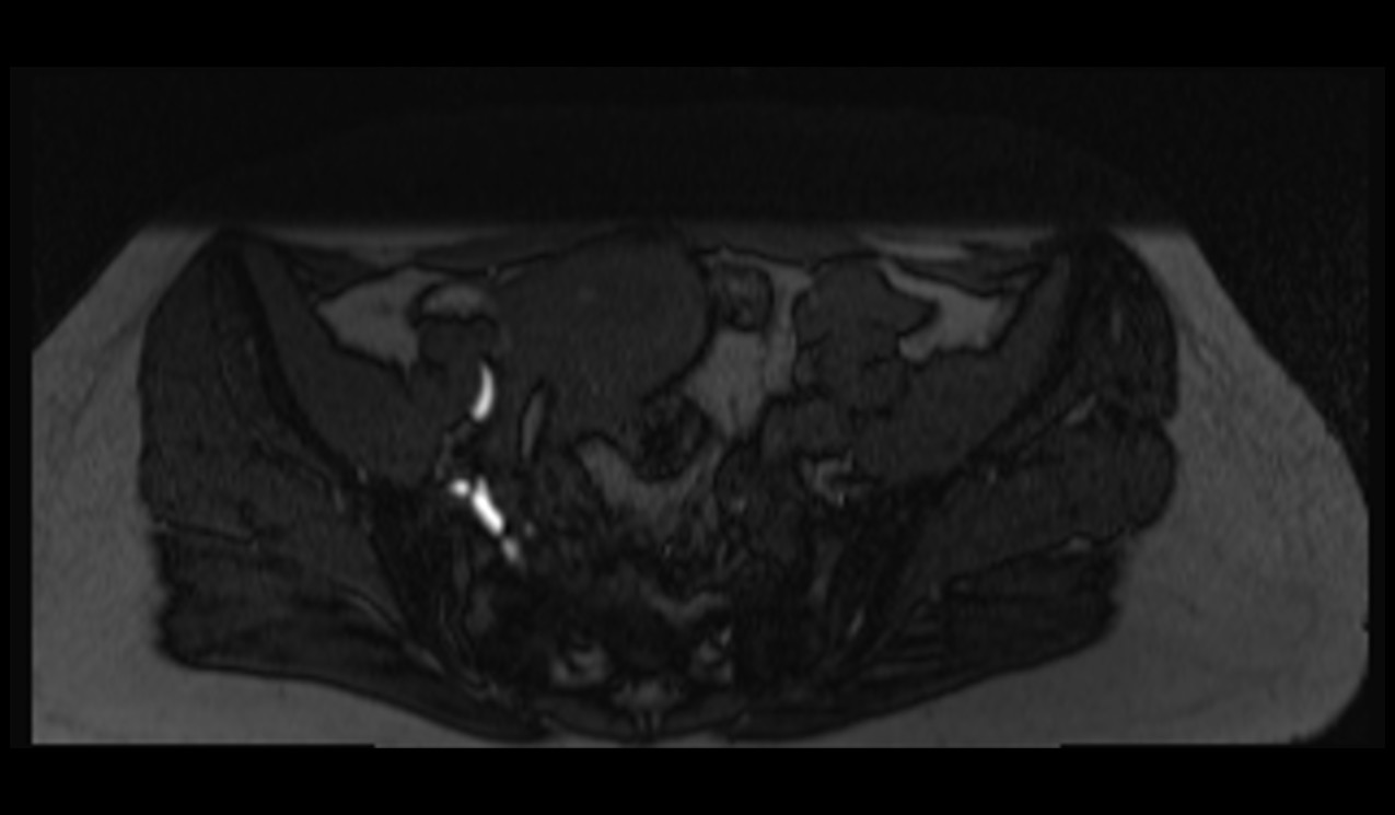 T2 TOF image of pelvis