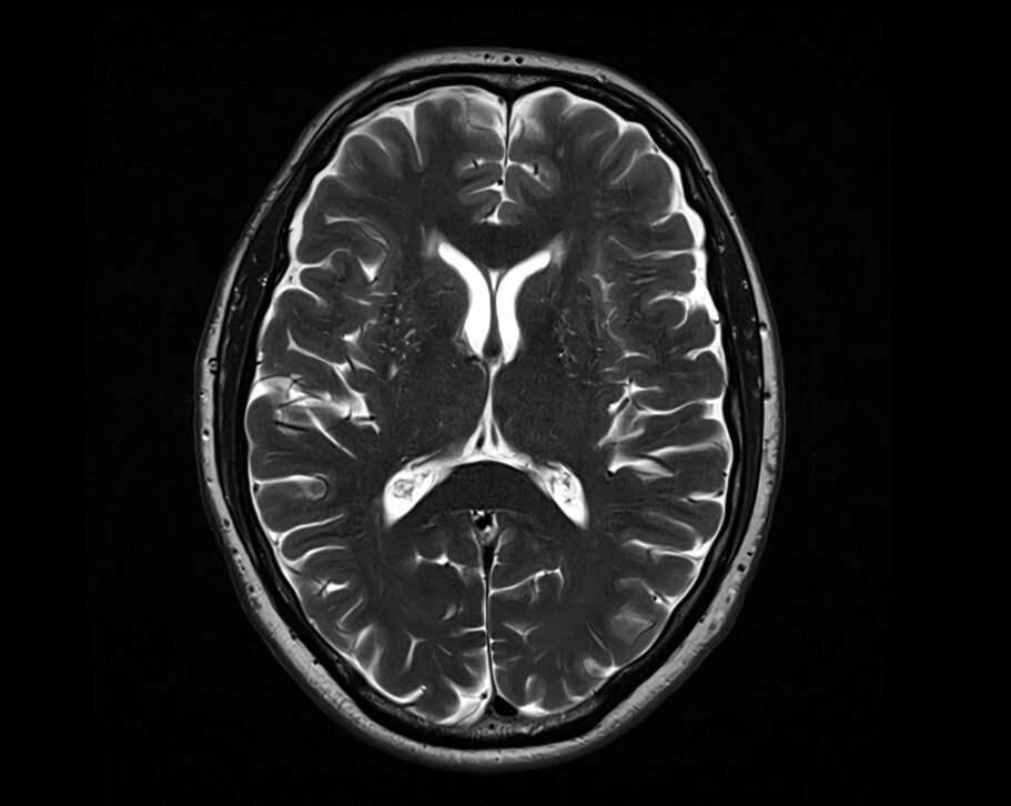 T2 axial sequence used in brain imaging