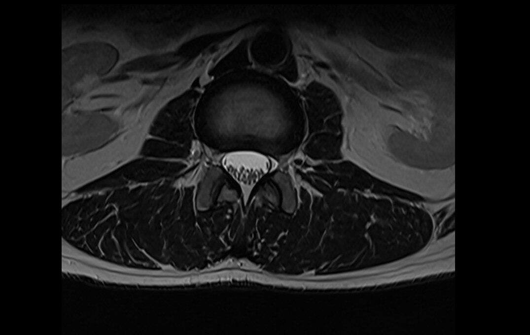 T2-weighted turbo spin-echo axial image of l spine