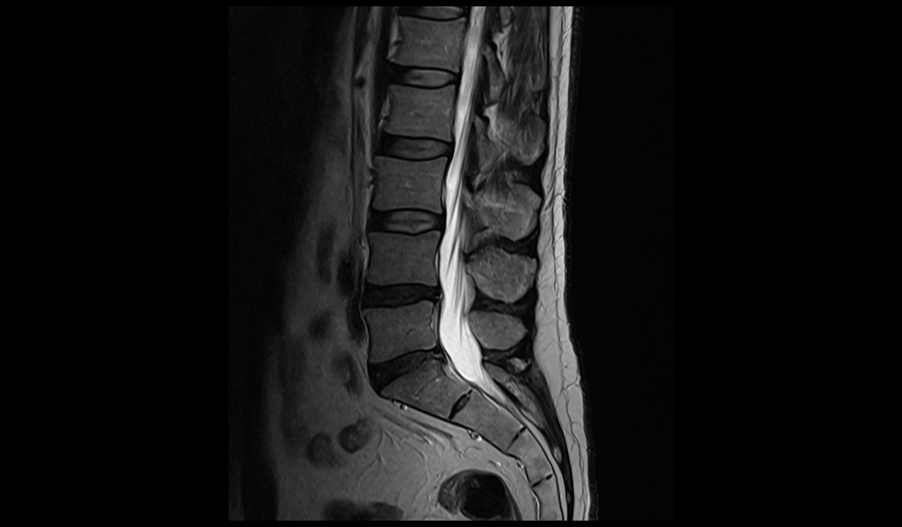 T2-weighted turbo spin-echo sagittal image of spine