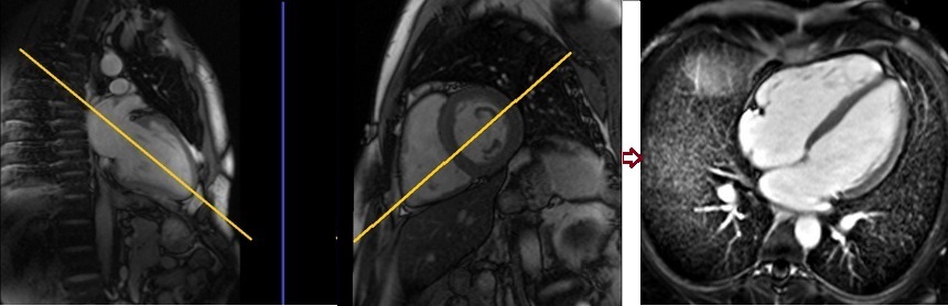 cardiac mri planning 4 chamber post contrast