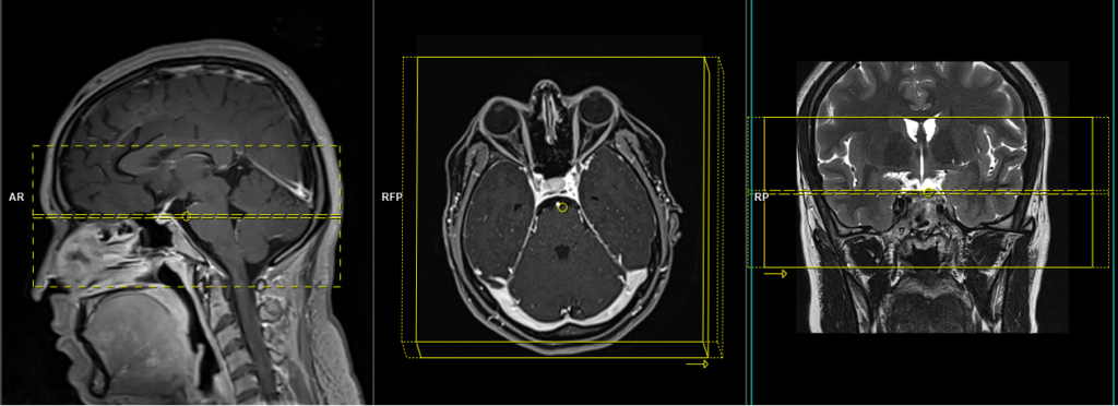 cavernus sinus MRI and MRA axial sfov planning