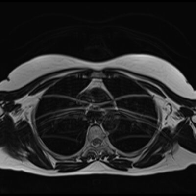 chest motion artifact chest motion artifact