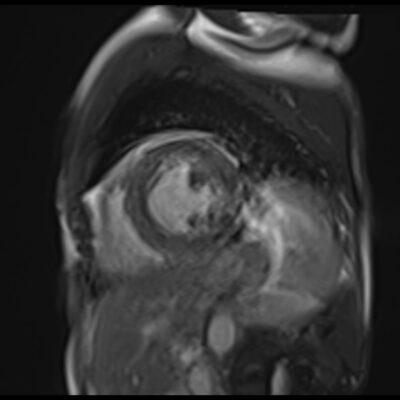 heart motion artifact heart motion artifact