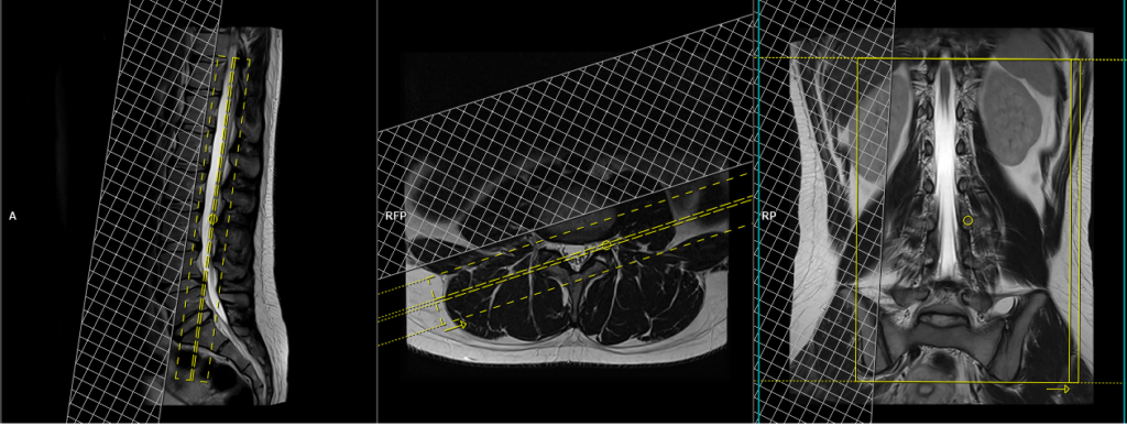 MRI left coronal oblique view plnning for exit foreamen