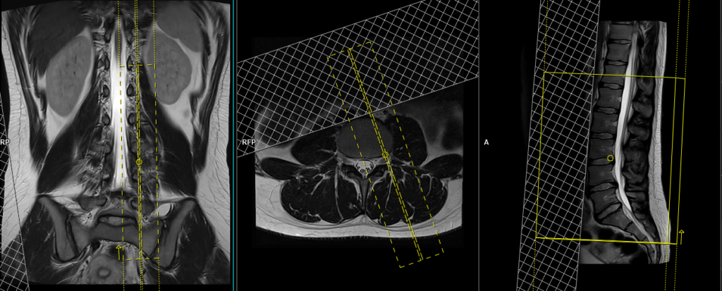 left sagittal oblique view plnning for exit foreamen