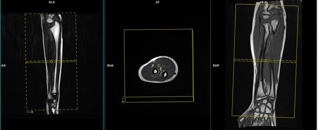 mri forearm protocol and planning of axial scans