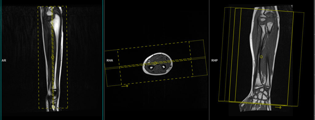 mri forearm protocol and planning of coronal scans