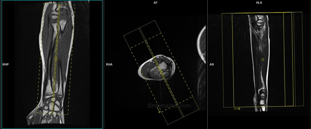 mri forearm protocol and planning of sagittal scans