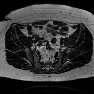mri motionartifact pelvis mri motionartifact pelvis