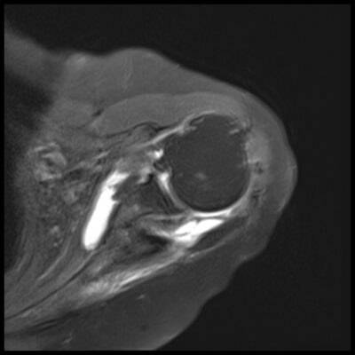 shoulder motion artifact shoulder motion artifact