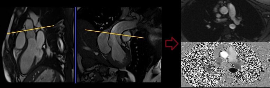 Aortic Flow velocity encoding scout planning