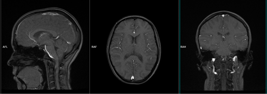 Brain MRI localiser image