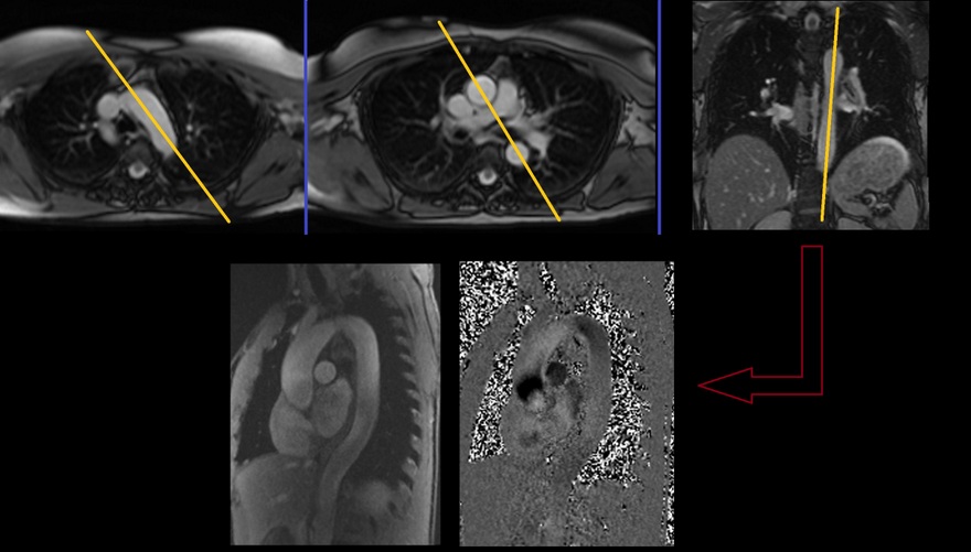 Cardiac MRI Aorta in plane flow planning (candy cane view).