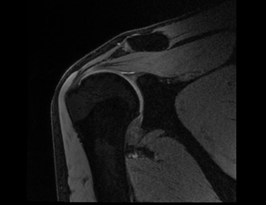 DESS 3D coronal image of shoulder