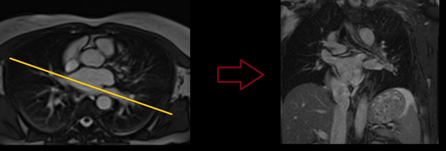 MRI Left PV flow planning