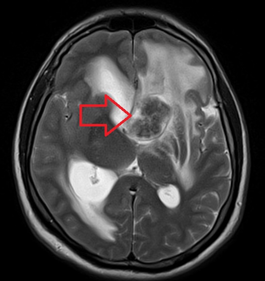 MRI Intracranial tuberculosis (TB) t2 axial image