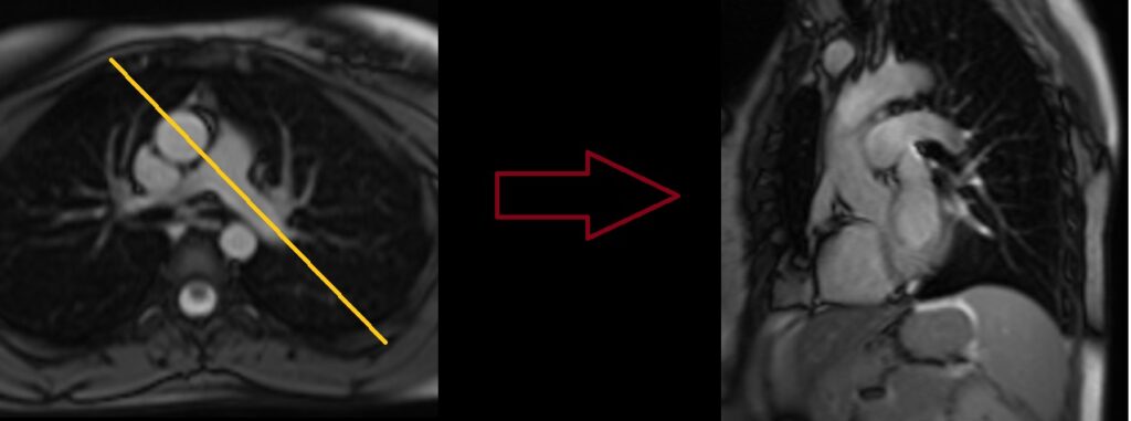 MRI Left Pulmonary artery flow coronal localizer