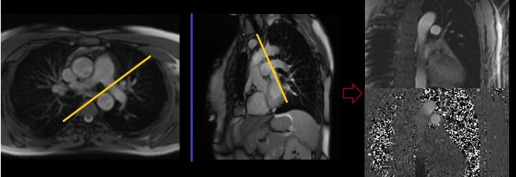 MRI Left Pulmonary artery through plane flow quantification planning