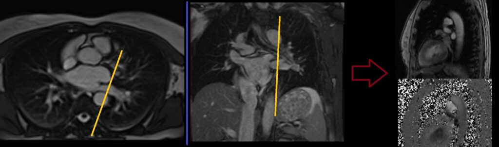 MRI Left Pulmonary vein through plane flow quantification planning