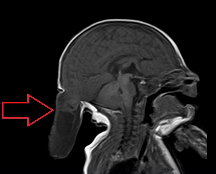 MRI Meningoencephalocele (Encephalocele) t1 sagittal image