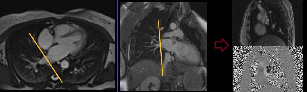 MRI Right Pulmonary vein through plane flow quantification planning