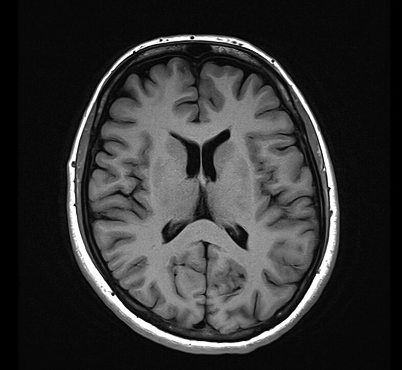 MRI T1 axial image of the brain