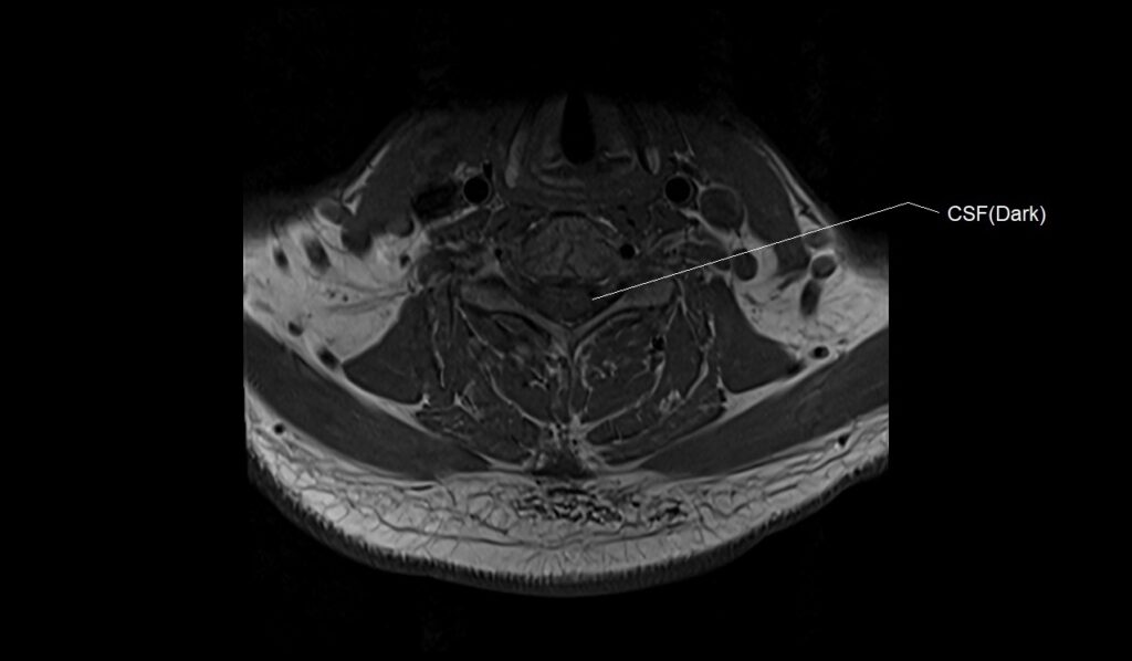 MRI T1 axial image of the cervical spine