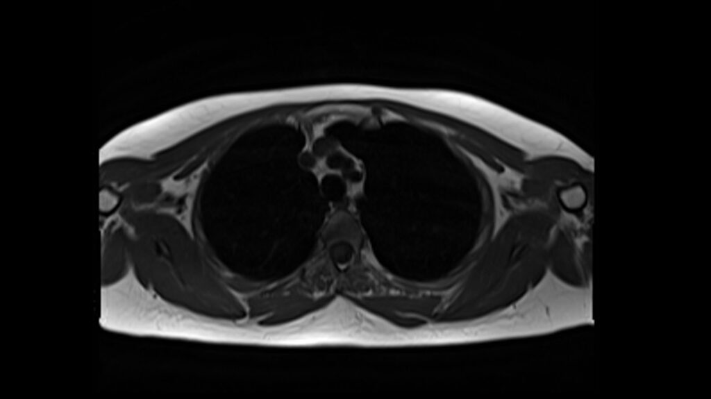 MRI T1 axial image of the chest