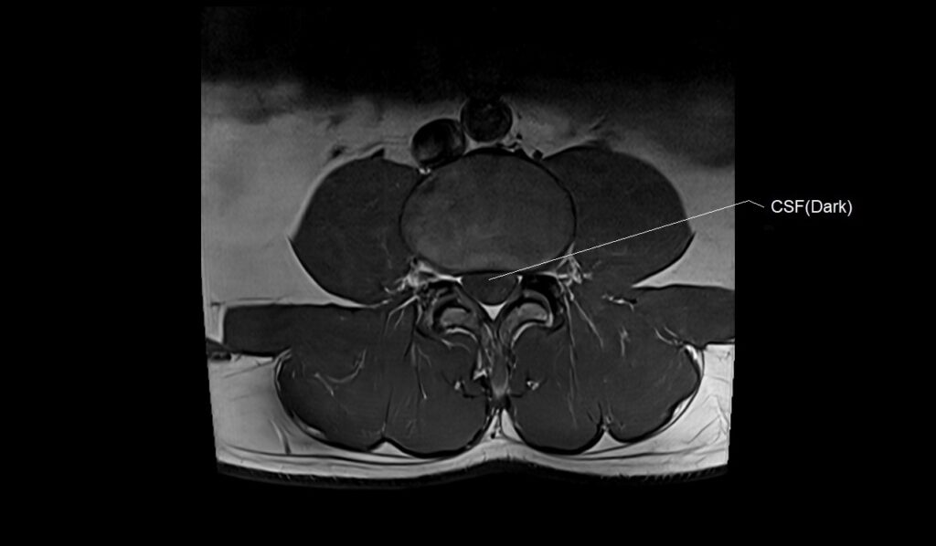 MRI T1 axial image of the spine