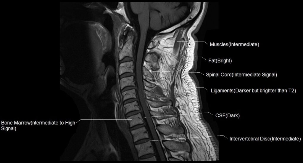 MRI T1 sagittal image of the cervical spine