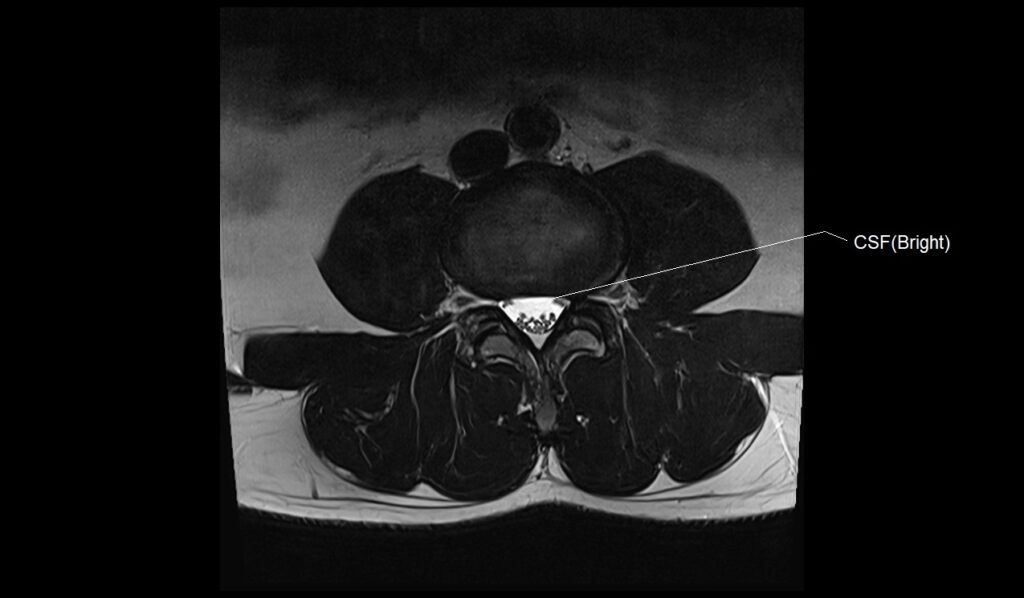 MRI T2 axial image of the lumbar spine