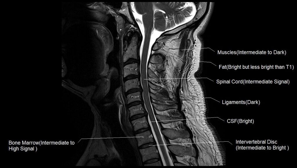 MRI T2 sagittal image of the cervical spine