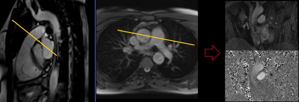 MRI cardiac Pulmonary trunk through plane flow quantification planning