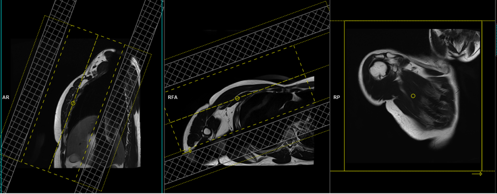 MRI pectoralis muscle planning and protocol of coronal t1 DIXON scans