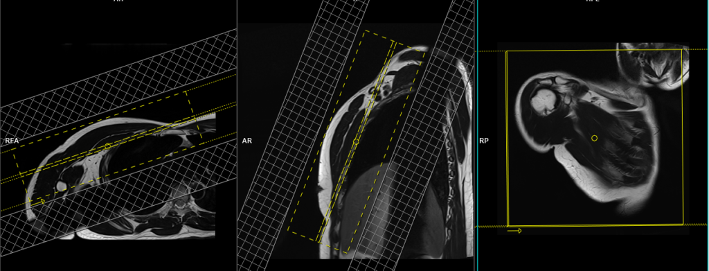 MRI pectoralis muscle planning of coronal images