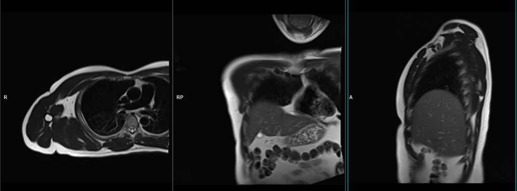 MRI pectoralis muscle scan localiser