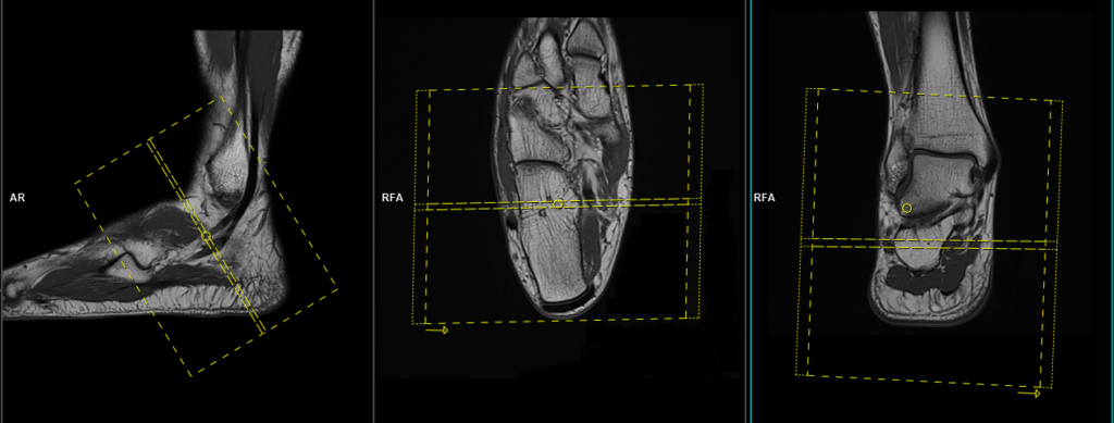 MRI peroneal tendon protocol and planning of axial oblique scans