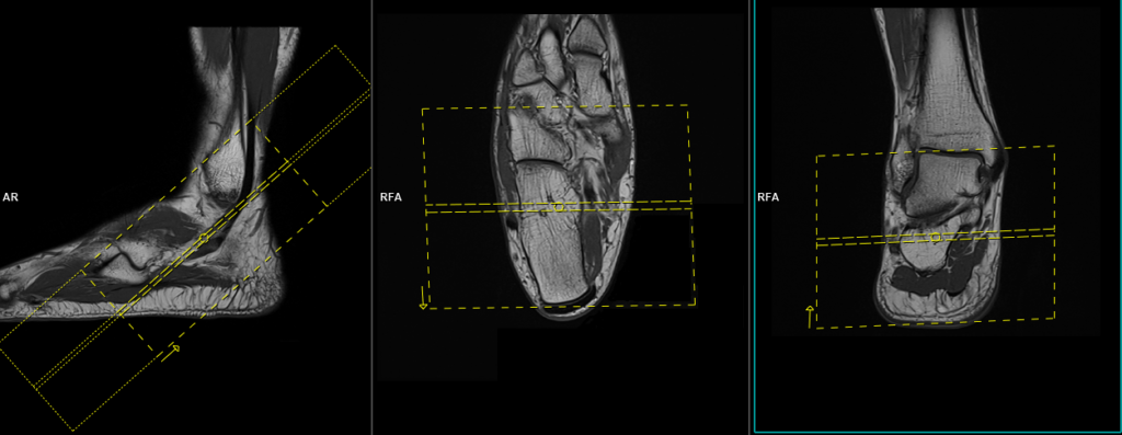 MRI peroneal tendon protocol and planning of coronal oblique scans
