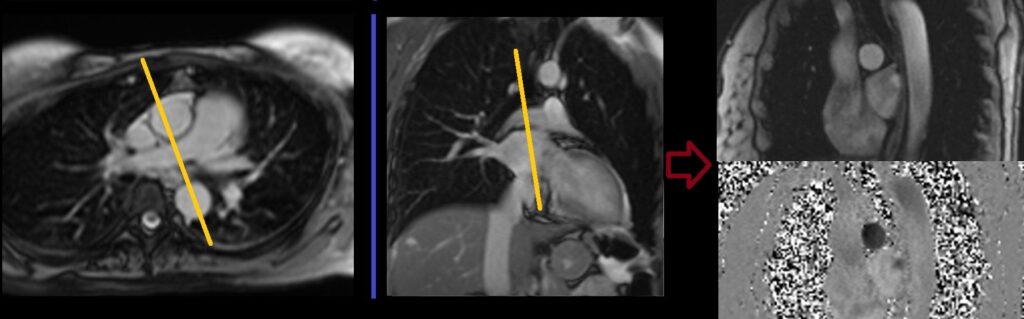 MRI right Pulmonary artery through plane flow planning