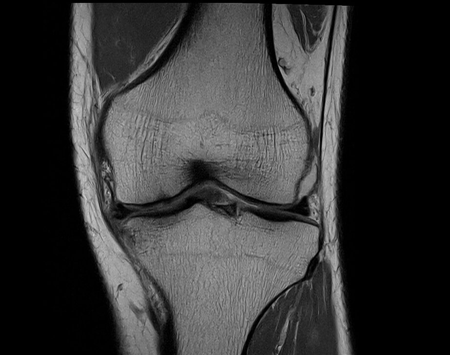 PD coronal image of Knee