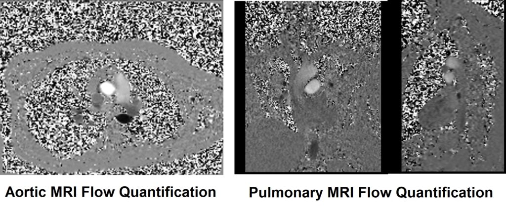 Pulmonary and aortic MRI flow quantification image