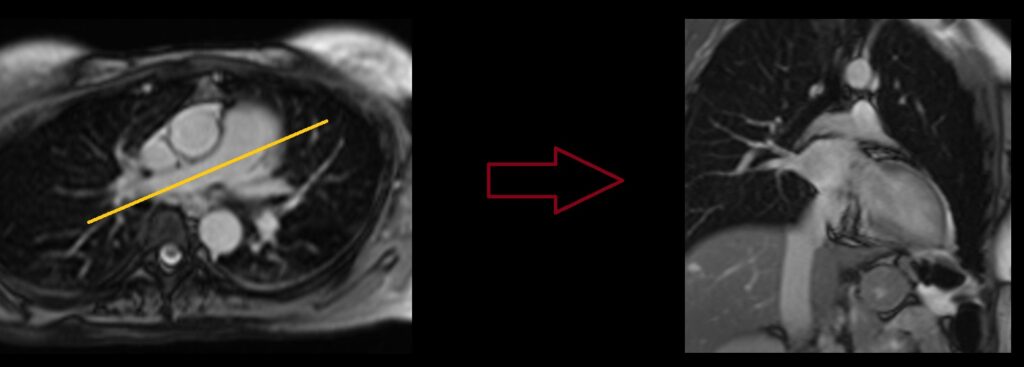 RT Pulmonary artery flow MRI coronal localizer